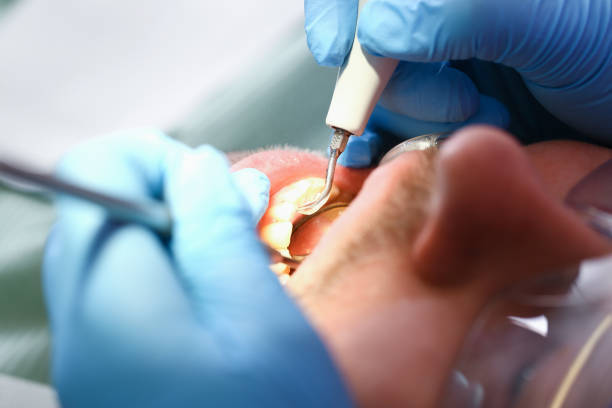 Best Emergency Root Canal Treatment in Cannelton, IN
